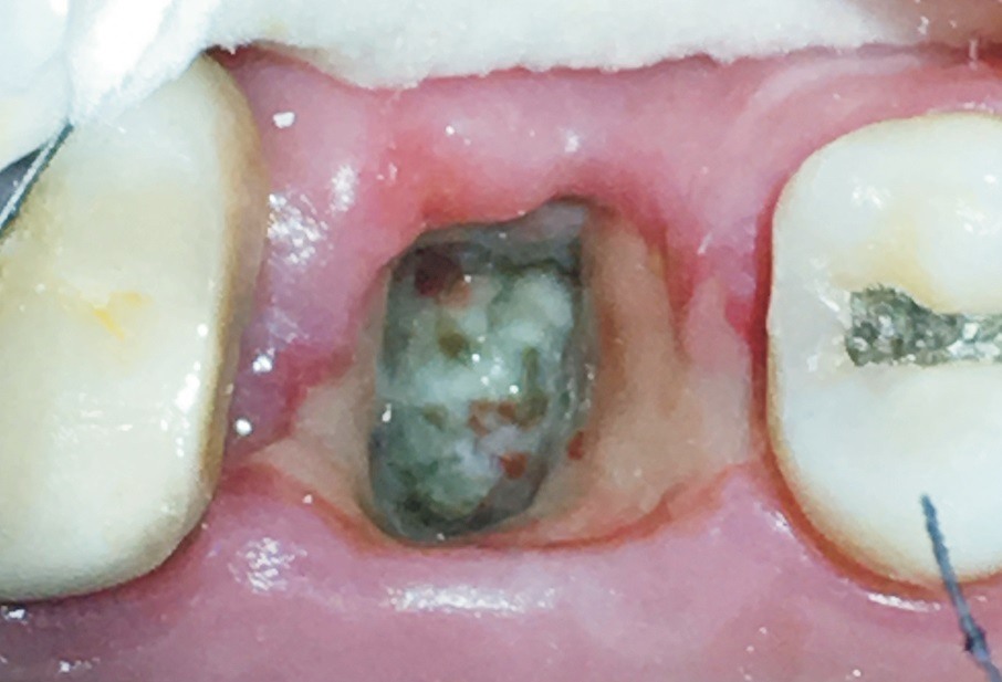 Dry Socket Can Be Managed Efficiently Know The Etiology Diagnosis