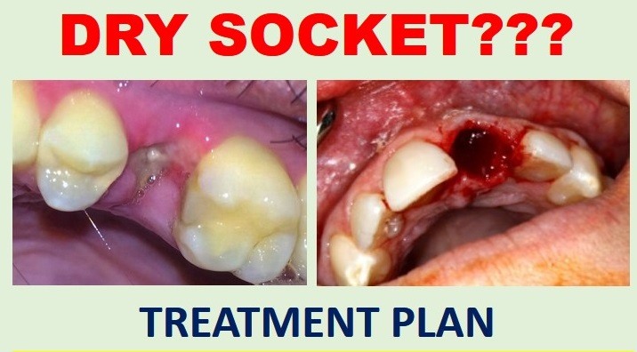 dry sockets in teeth